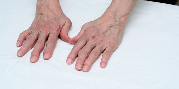 What You Need To Know About Rheumatoid Arthritis Healthdish