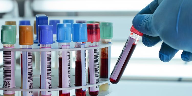 Photo of blood samples in laboratory