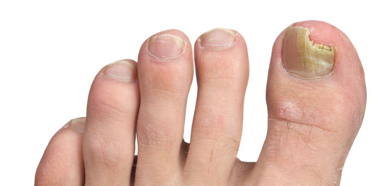 Photo of a fungal infection on a toe